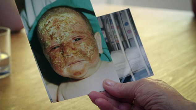 Alex's skin burnt while he was a child (BBC Two)