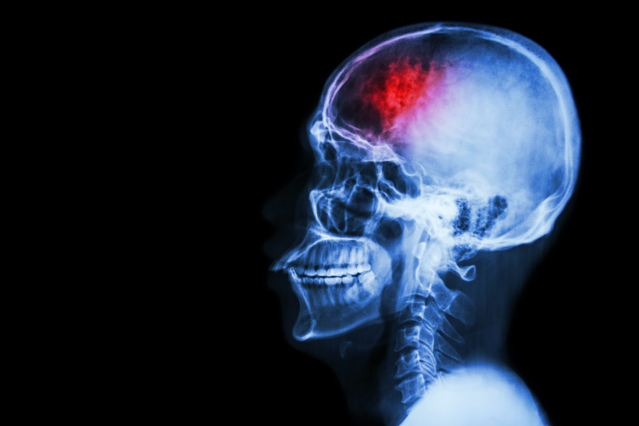 Medics had initially thought she suffered a seizure, but later diagnosed a rare type of bleeding on the brain which was relatively "small" in size. (iStock)