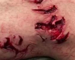 Wounds affected by the flesh-eating bacteria (GoFundMe Page)