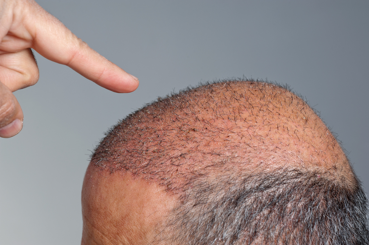 Choudhary, who ran a logistics firm, reportedly asked the doctor for 9,000 grafts in one sitting - three times over the recommended limit. (iStock)